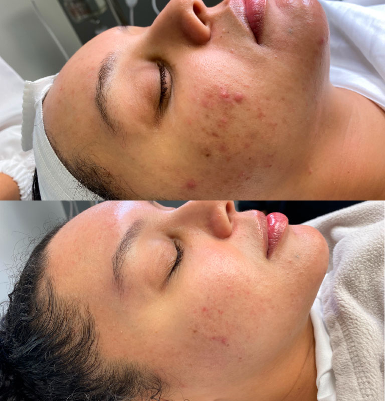 Acne Treatment before and after images by Pelle Dolce