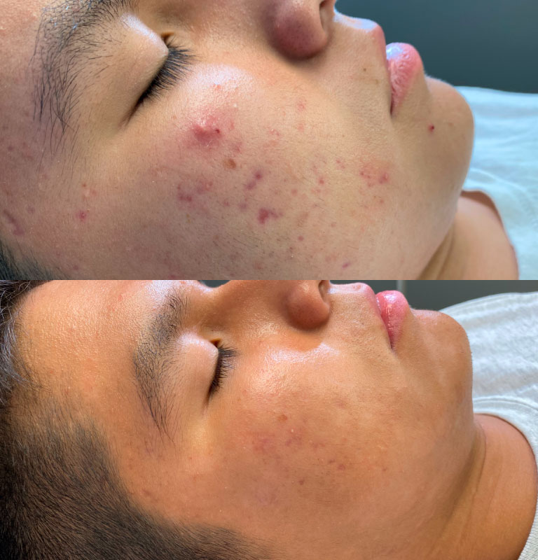 Acne Treatment before and after images by Pelle Dolce