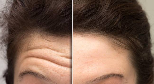 Is Xeomin Injectable Best for Wrinkles_ Is It Right For You_