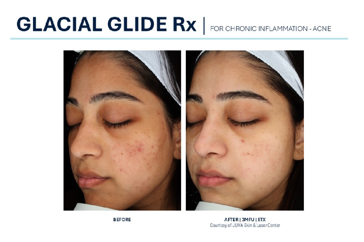 Glacial Glide Rx (1)