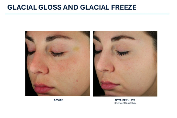 Glacial Gloss And Glacial Freeze