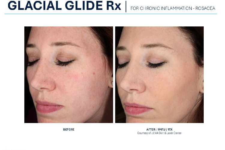 Lacial Glide Rx