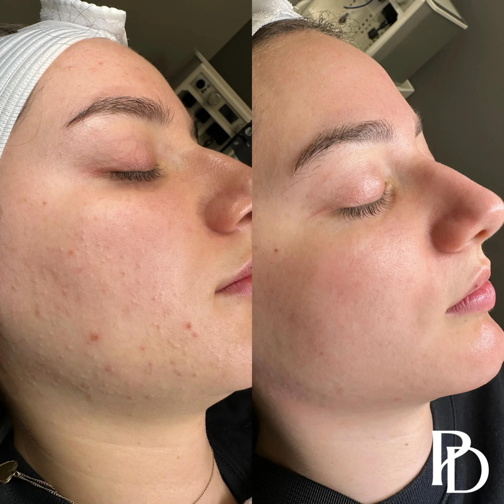 Acne Boot Camp Before & after (2)