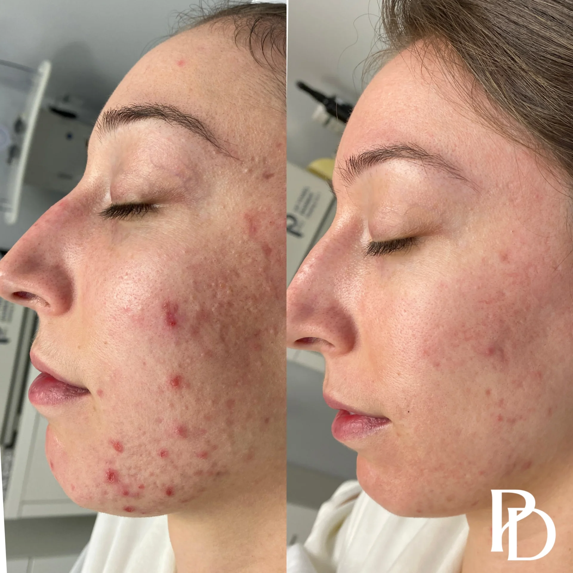 Acne Boot Camp Before & after (3)