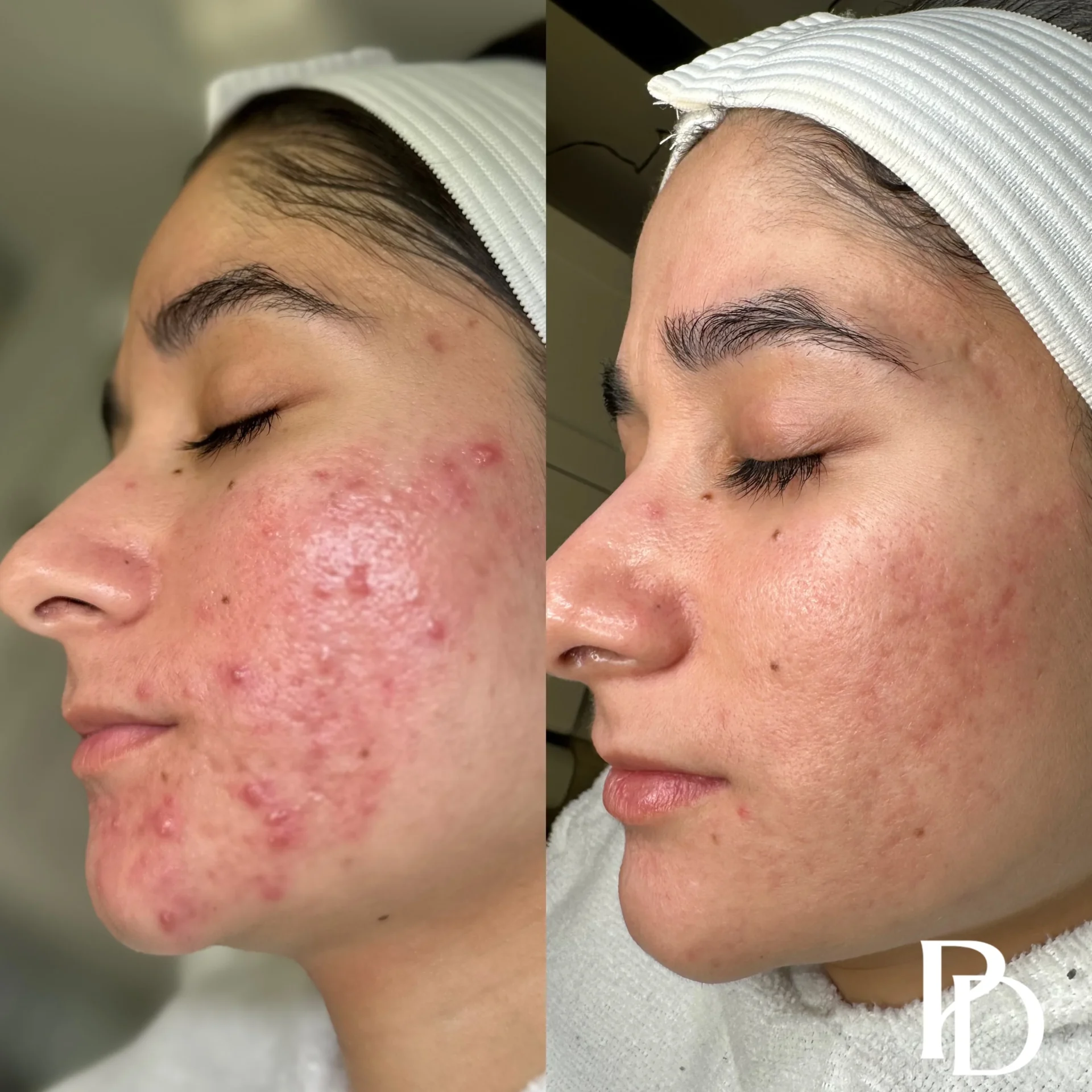 Acne Boot Camp Before & after (4)