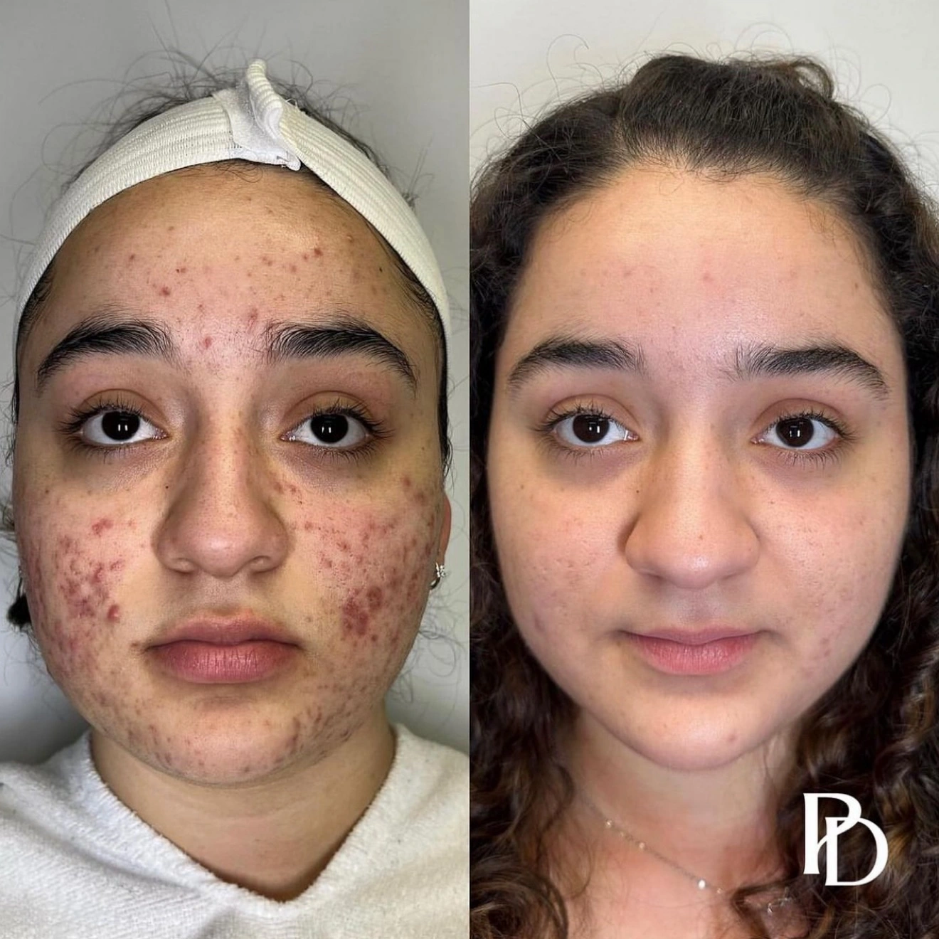 Acne Boot Camp Before & after (5)
