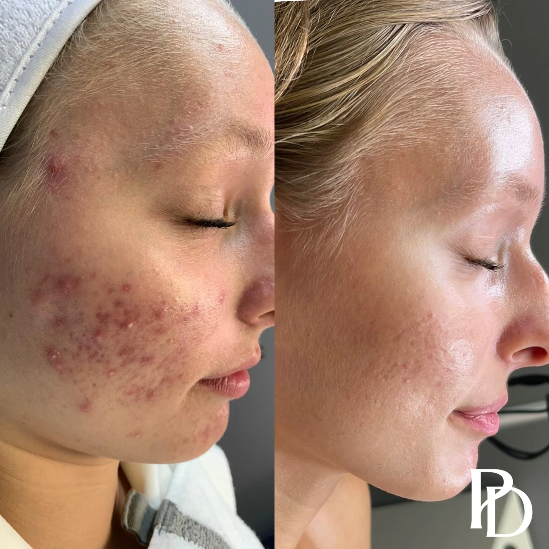 Acne Boot Camp Before & after