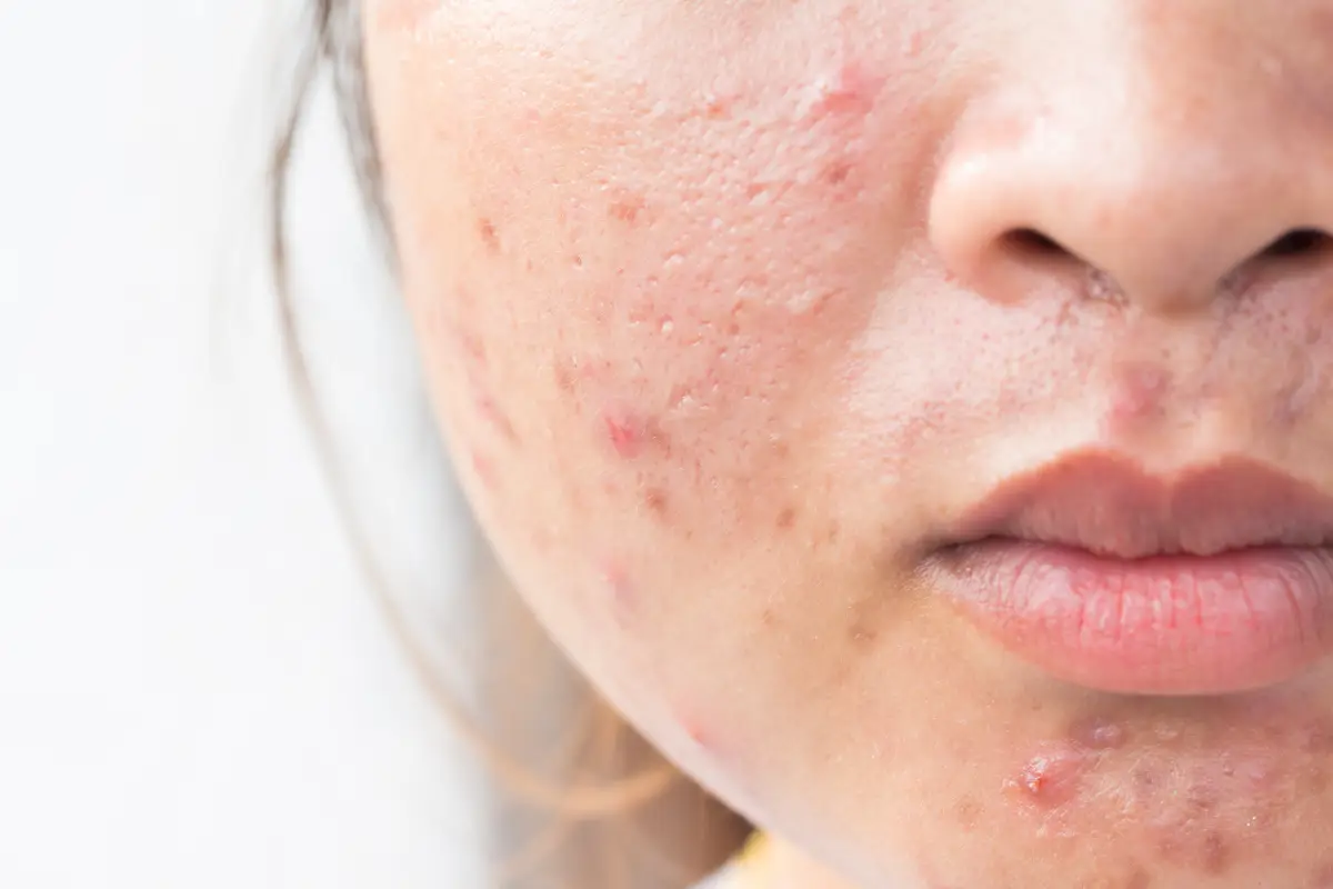 Inflamed Blemishes and Dark Marks in Your 20s - How Acne Bootcamp Improves Skin Clarity