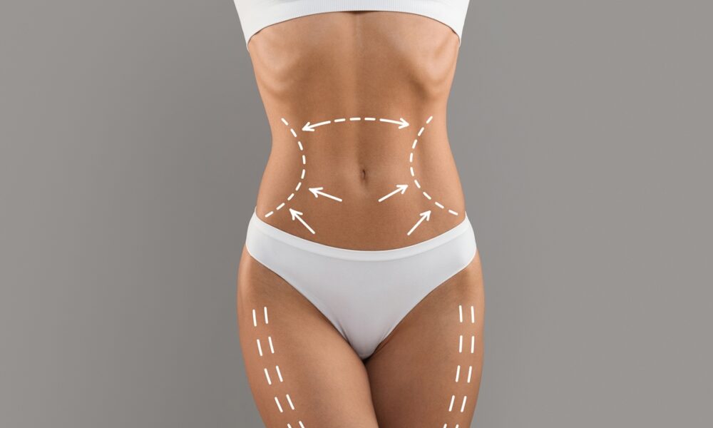 Non-Surgical Body Contouring with Lipomax Sculpt