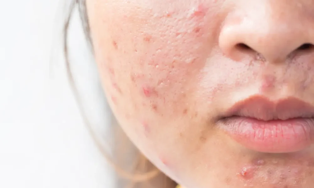 Inflamed Blemishes and Dark Marks in Your 20s - How Acne Bootcamp Improves Skin Clarity