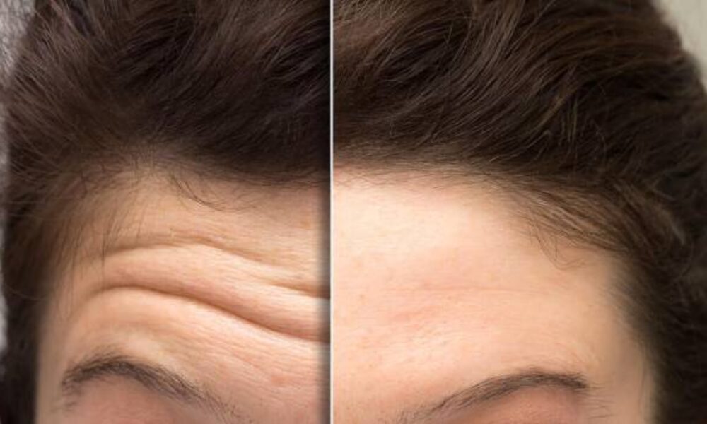 Is Xeomin Injectable Best for Wrinkles_ Is It Right For You_